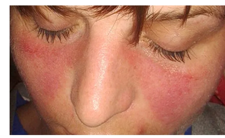 系統性紅斑狼瘡癥狀、病因和治療方法