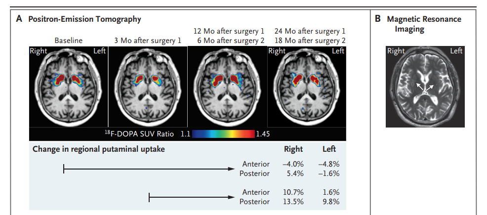 顯示了指示的時間點在基底神經節水平的軸向氟18-L-二羥基苯丙氨酸(18 F-DOPA)正電子發射斷層掃描圖像 顯示了指示的時間點在基底神經節水平的軸向氟18-L-二羥基苯丙氨酸(18 F-DOPA)正電子發射斷層掃描圖像