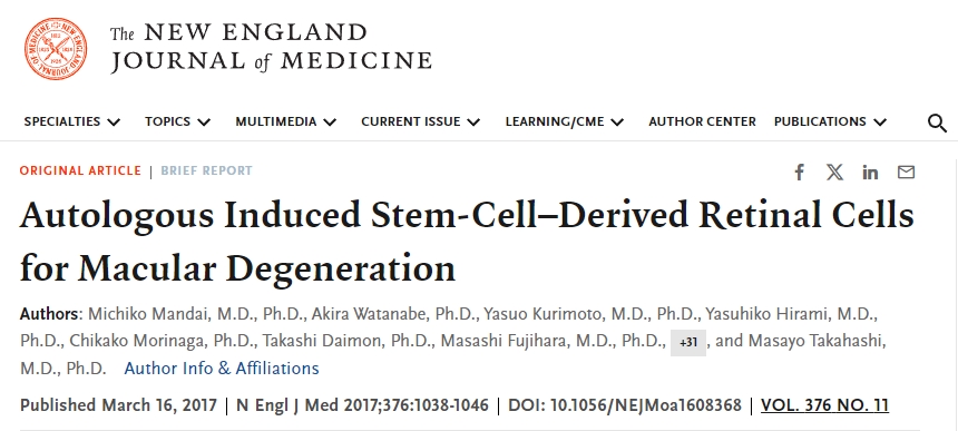 自體誘導(dǎo)干細(xì)胞來(lái)源的視網(wǎng)膜細(xì)胞用于治療黃斑變性 自體誘導(dǎo)干細(xì)胞來(lái)源的視網(wǎng)膜細(xì)胞用于治療黃斑變性