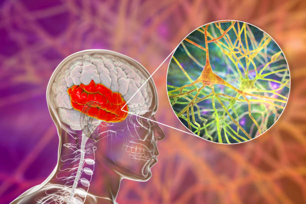 如何治療精神分裂癥？