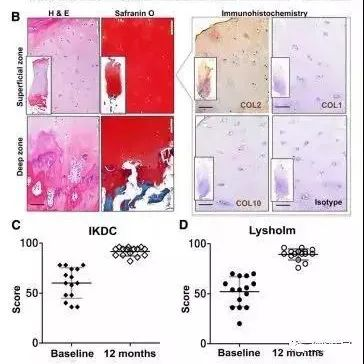 干細胞治療膝骨關節炎臨床案例 干細胞治療膝骨關節炎臨床案例