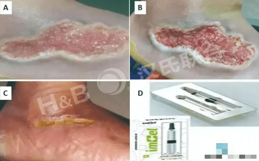 糖尿病足潰瘍患者使用胎盤衍生間充質(zhì)干細(xì)胞水凝膠進(jìn)行三周局部治療:病例報(bào)告。 糖尿病足潰瘍患者使用胎盤衍生間充質(zhì)干細(xì)胞水凝膠進(jìn)行三周局部治療:病例報(bào)告。