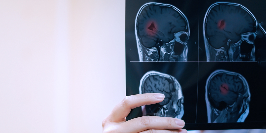 多發(fā)性硬化癥的干細胞療法:探索神經(jīng)免疫學(xué)的新前沿 多發(fā)性硬化癥的干細胞療法:探索神經(jīng)免疫學(xué)的新前沿