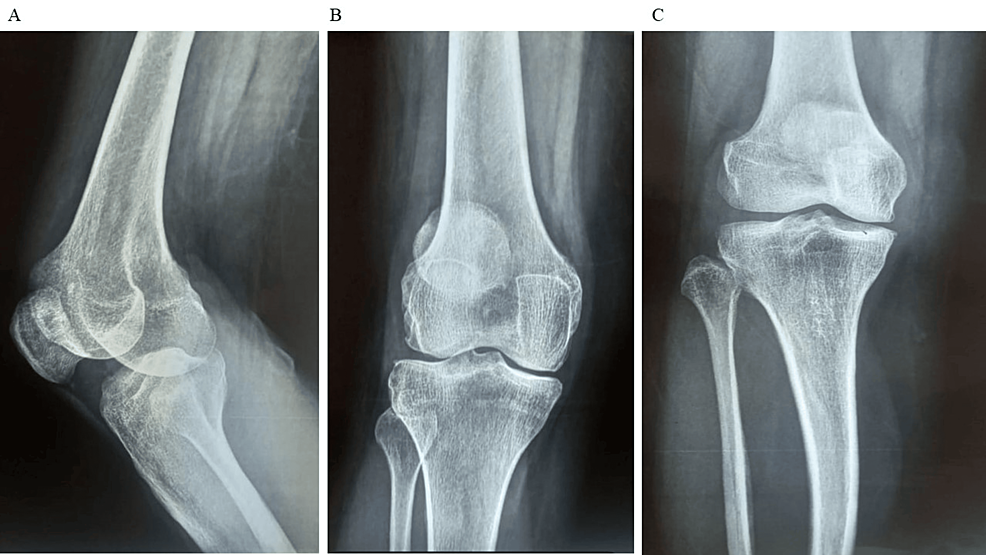 圖1:顯示了開始干細(xì)胞治療之前的骨骼側(cè)視圖和前后視圖。 圖1:顯示了開始干細(xì)胞治療之前的骨骼側(cè)視圖和前后視圖。
