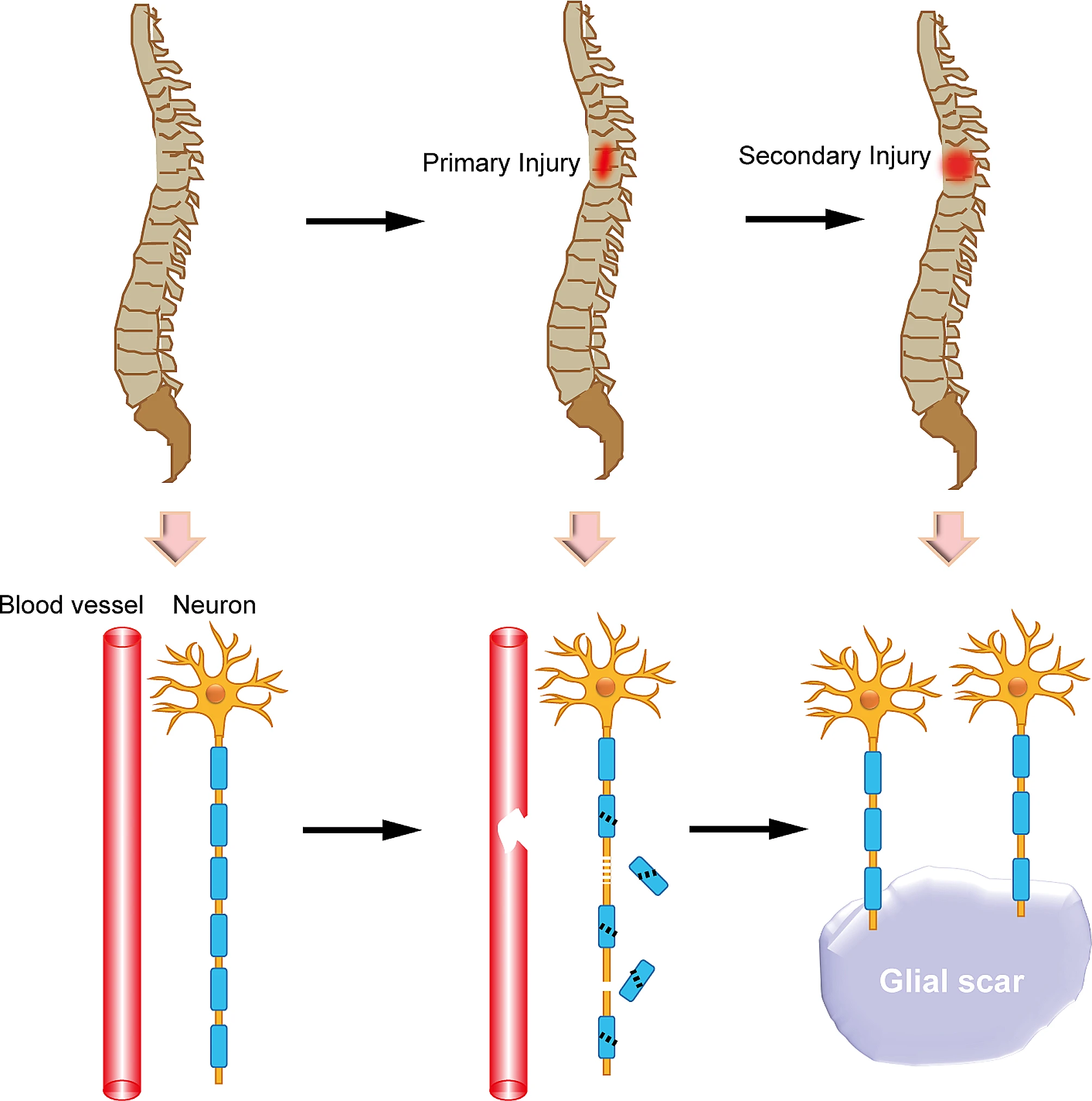 圖1:脊髓損傷后的原發(fā)性和繼發(fā)性損傷 圖1:脊髓損傷后的原發(fā)性和繼發(fā)性損傷