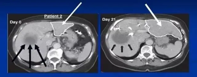 干細(xì)胞治療肝硬化的治療效果如何? 干細(xì)胞治療肝硬化的治療效果如何?