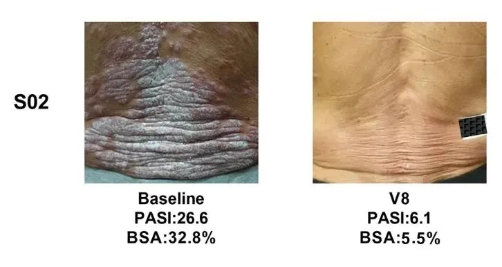 總共47.1% (8/17)的銀屑病患者在PASI（皮損面積和嚴重程度）評分中有至少40%的改善