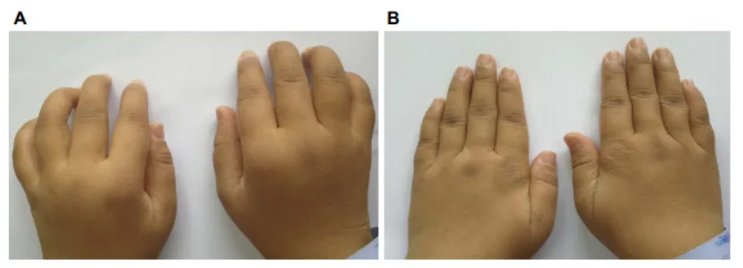 33歲女性,患病4年,治療前后對比 33歲女性,患病4年,治療前后對比