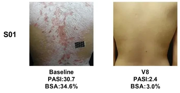 同種異體UMSCs的移植對銀屑病患者安全且部分有效，尤其對女性銀屑病患者