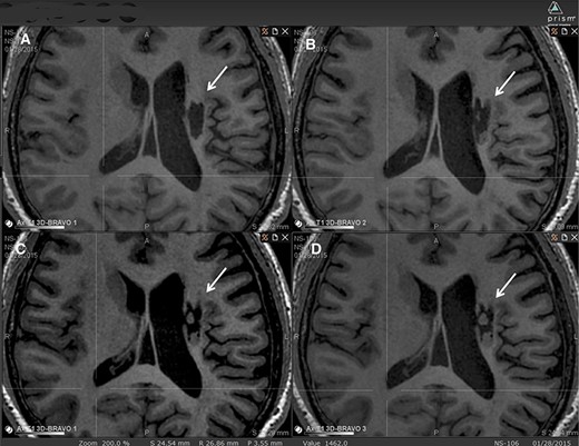 圖2：腔內(nèi)組織生長的縱向MRI示例。