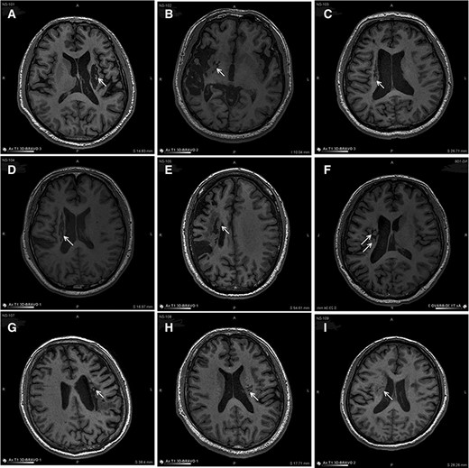 圖3：NSI-566移植后最新隨訪時(shí)梗塞部位的MRI。