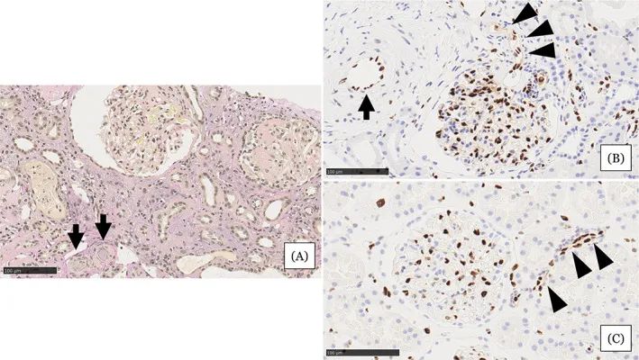 在住院第31天進行的腎活檢結果
