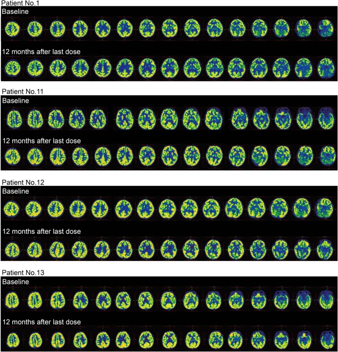 圖3：干預后腦代謝變化。