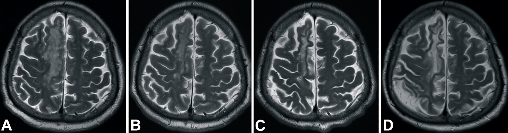 中風后2小時和輸血后6個月獲得的T2加權圖像。 中風后2小時和輸血后6個月獲得的T2加權圖像。
