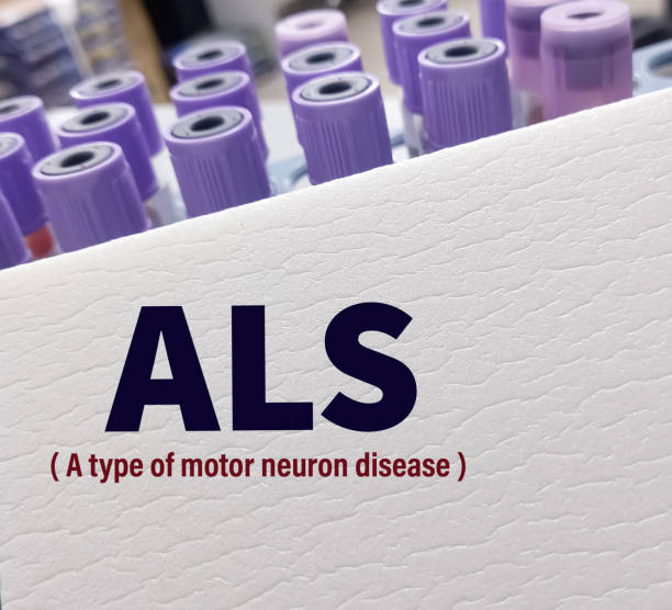 干細胞治療漸凍癥:78例患者的安全性與有效性驗證 干細胞治療漸凍癥:78例患者的安全性與有效性驗證