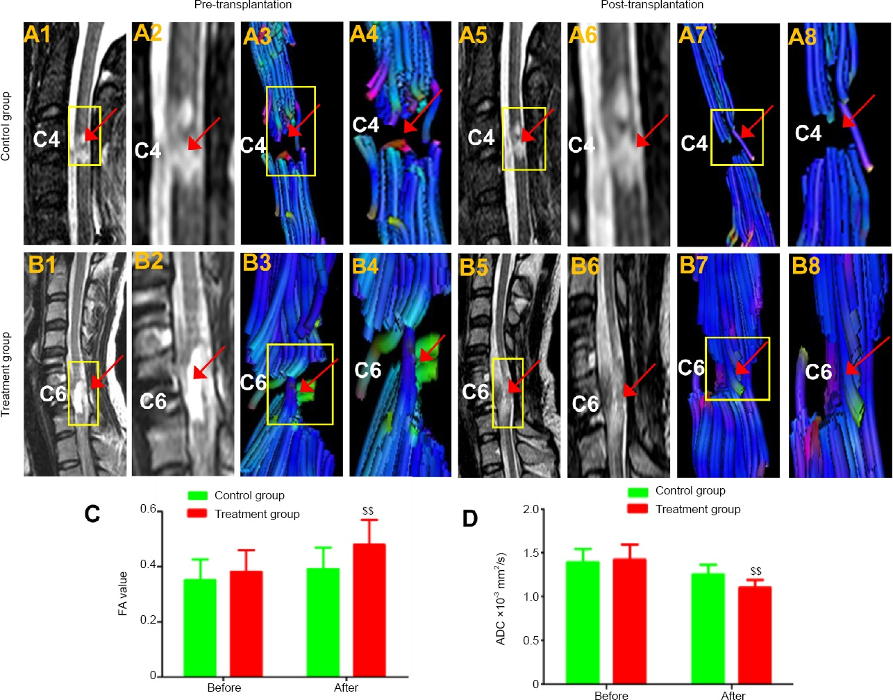磁共振成像和擴(kuò)散張量成像結(jié)果 磁共振成像和擴(kuò)散張量成像結(jié)果
