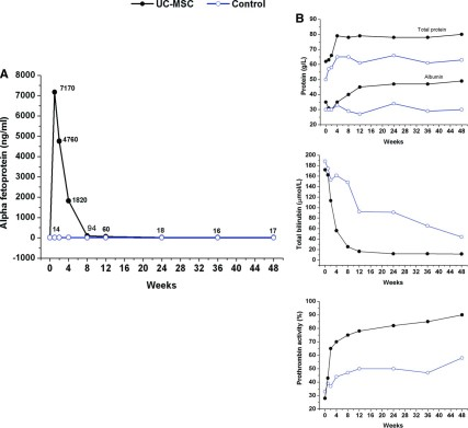 UC-MSC 輸血改善了一名急性慢性肝衰竭患者的血清 α-胎蛋白 (α-FP) 水平。 UC-MSC 輸血改善了一名急性慢性肝衰竭患者的血清 α-胎蛋白 (α-FP) 水平。