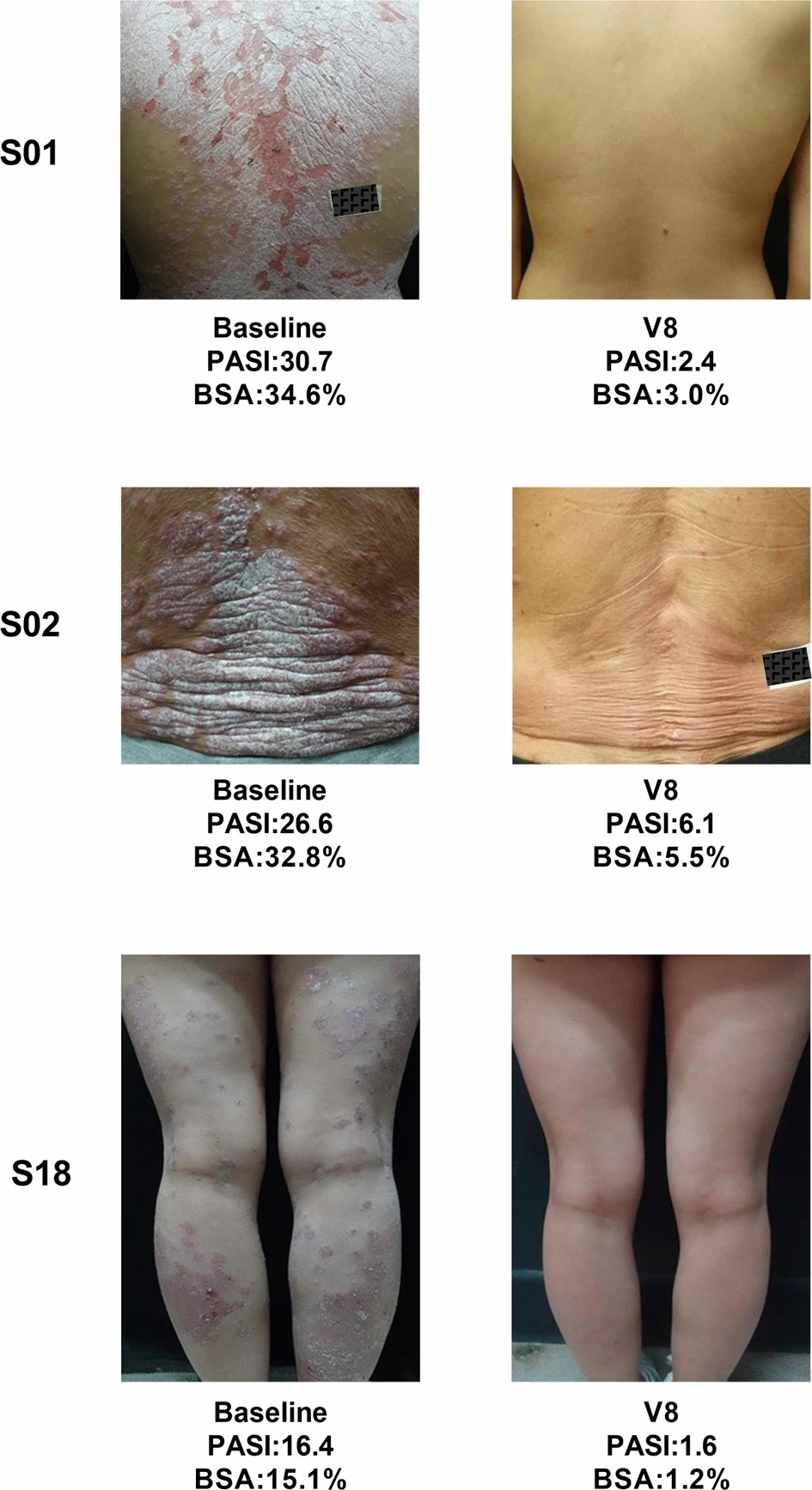 三名患者經過治療后根據 PGA 評分顯示無疾病跡象(評分為 0)或輕微疾病(評分為 1)。 三名患者經過治療后根據 PGA 評分顯示無疾病跡象(評分為 0)或輕微疾病(評分為 1)。