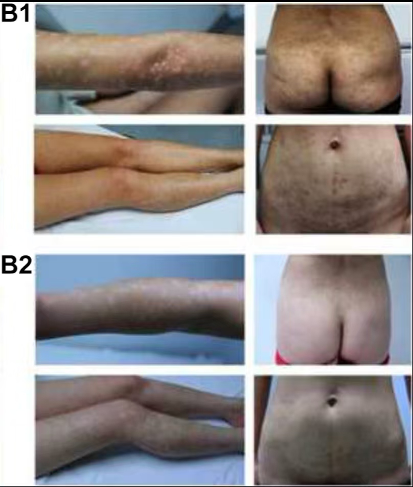 (圖B1)患者入院后體檢發現,患者全身遍布橙紅色斑塊,上面覆有銀色鱗屑 (圖B2)治療初期,我院給予患者3次臍帶間充質干細胞(每次1×10?6?/Kg),連續3周回輸,患者全身表面逐漸恢復光滑 (圖B1)患者入院后體檢發現,患者全身遍布橙紅色斑塊,上面覆有銀色鱗屑
(圖B2)治療初期,我院給予患者3次臍帶間充質干細胞,連續3周回輸,患者全身表面逐漸恢復光滑