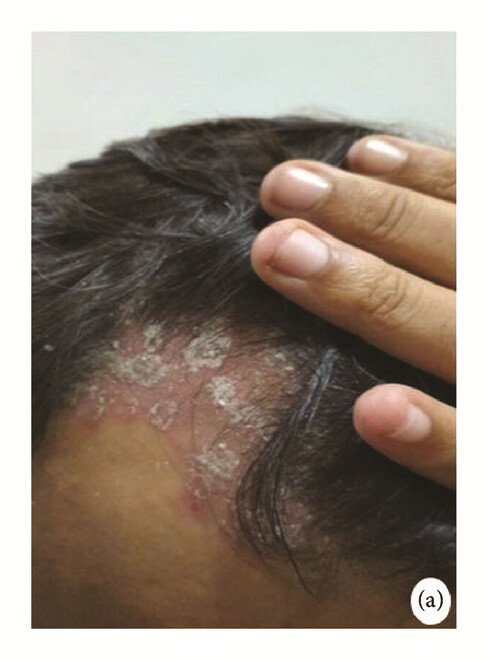 骨髓間充質干細胞 治療前,患者頭皮上出現大量紅斑,并附著銀色鱗片(a)。 骨髓間充質干細胞 治療前,患者頭皮上出現大量紅斑,并附著銀色鱗片(a)。