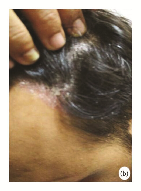 骨髓間充質干細胞 治療前,患者頭皮上出現大量紅斑,并附著銀色鱗片(b)。 骨髓間充質干細胞 治療前,患者頭皮上出現大量紅斑,并附著銀色鱗片(b)。
