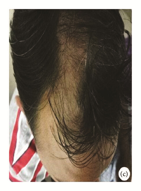 局部應用骨髓間充質干細胞一個月后,銀屑病消退,炎性紅斑完全清除(c)。 局部應用骨髓間充質干細胞一個月后,銀屑病消退,炎性紅斑完全清除(c)。