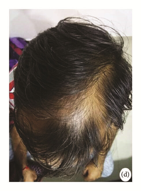 局部應用骨髓間充質干細胞一個月后,銀屑病消退,炎性紅斑完全清除(d)。 局部應用骨髓間充質干細胞一個月后,銀屑病消退,炎性紅斑完全清除(d)。