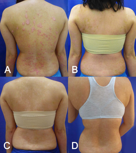 (圖2A)基線(細胞移植前);(圖2B)首次輸注后 30 天;(圖C2) 121 天后;(圖2D)231 天后。 (圖2A)基線(細胞移植前);(圖2B)首次輸注后 30 天;(圖C2) 121 天后;(圖2D)231 天后。