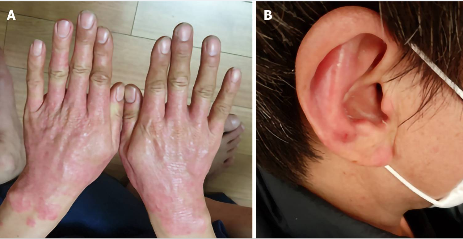 圖1A:移植微創臍帶間充質干細胞(MM-UC-MSCs)前手部及腕部銀屑病病變部位; 圖1B:移植臍帶間充質干細胞前的耳朵。 治療前銀屑病病變部位