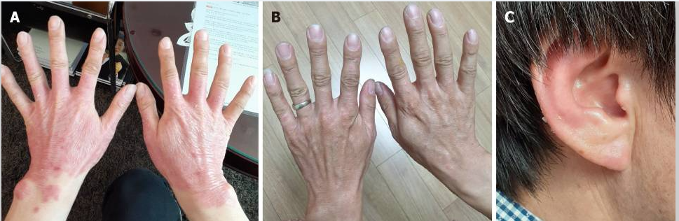 治療后銀屑病病變部位 治療后銀屑病病變部位