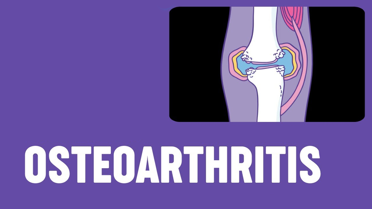 5項研究171例患者，評估干細胞治療骨關(guān)節(jié)炎的安全性和有效性
