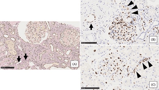 圖1：住院第 31 天的腎臟活檢結果。