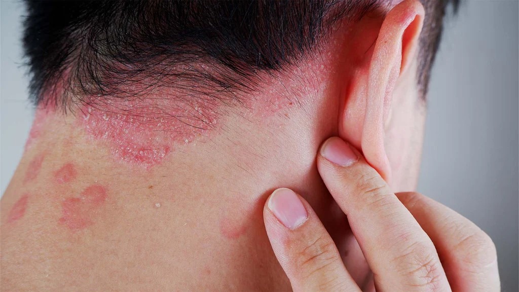 銀屑病如何治療?干細胞療法如何為銀屑病患者掃除障礙? 銀屑病如何治療?干細胞療法如何為銀屑病患者掃除障礙?