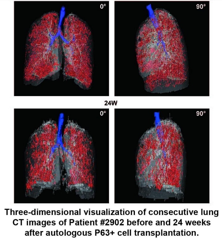 患者#2902在自體P63+細胞移植前后24周連續肺部CT圖像的三維可視化。 患者#2902在自體P63+細胞移植前后24周連續肺部CT圖像的三維可視化。