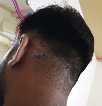 圖 1:圖像顯示患者頭皮牛皮癬有銀色鱗片和斑塊 圖 1:圖像顯示患者頭皮牛皮癬有銀色鱗片和斑塊