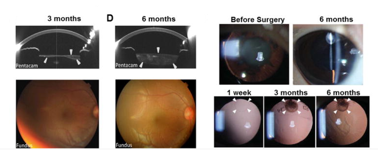 手術后六個月，囊袋充滿了再生晶狀體組織