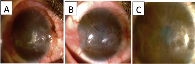 右眼 眼表鱗狀腫瘤照片。