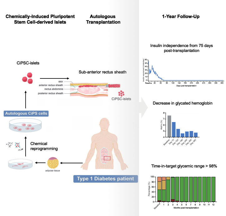 基于CiPS細胞治療1型糖尿病的臨床研究的示意圖和治療效果 基于CiPS細胞治療1型糖尿病的臨床研究的示意圖和治療效果