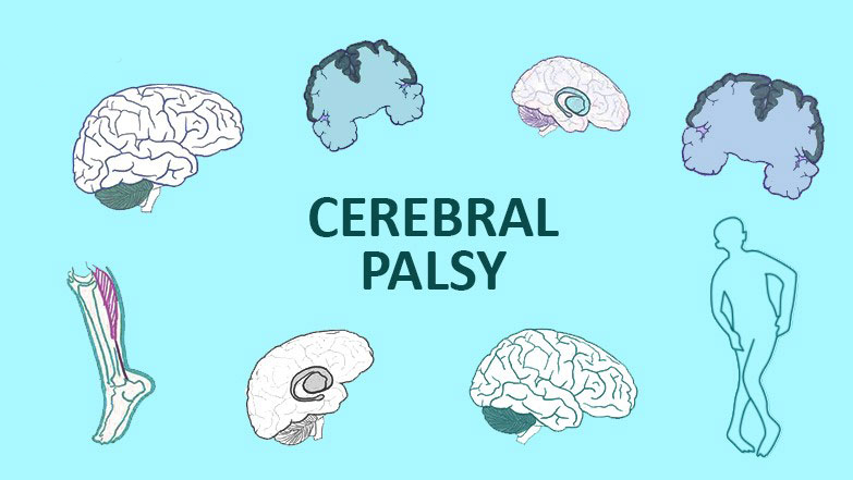 從步履蹣跚到穩健行走：干細胞技術如何重塑腦癱兒童平衡能力？