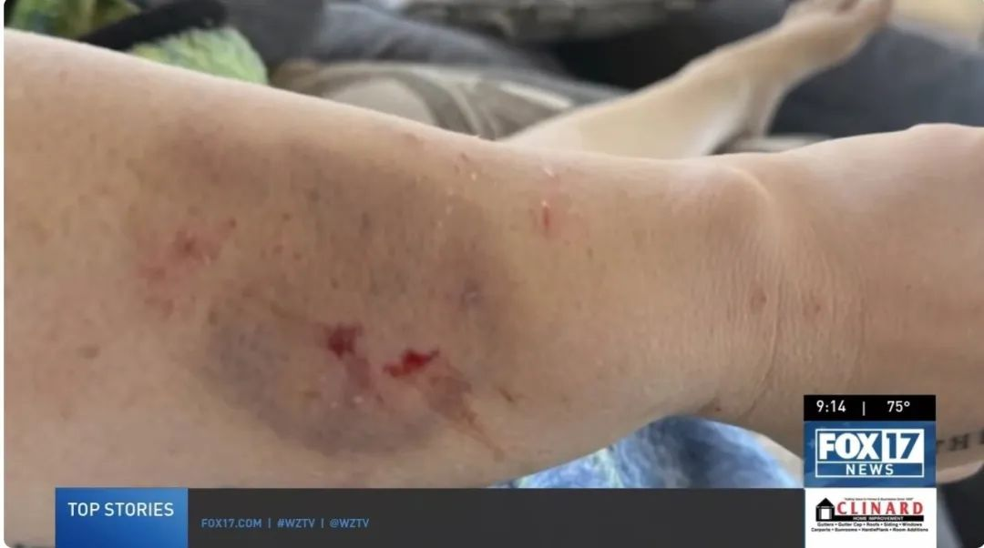 在接受干細胞治療前表現出嚴重的自閉癥癥狀,甚至曾咬傷母親安吉拉,留下了永久的疤痕 在接受干細胞治療前表現出嚴重的自閉癥癥狀,甚至曾咬傷母親安吉拉,留下了永久的疤痕