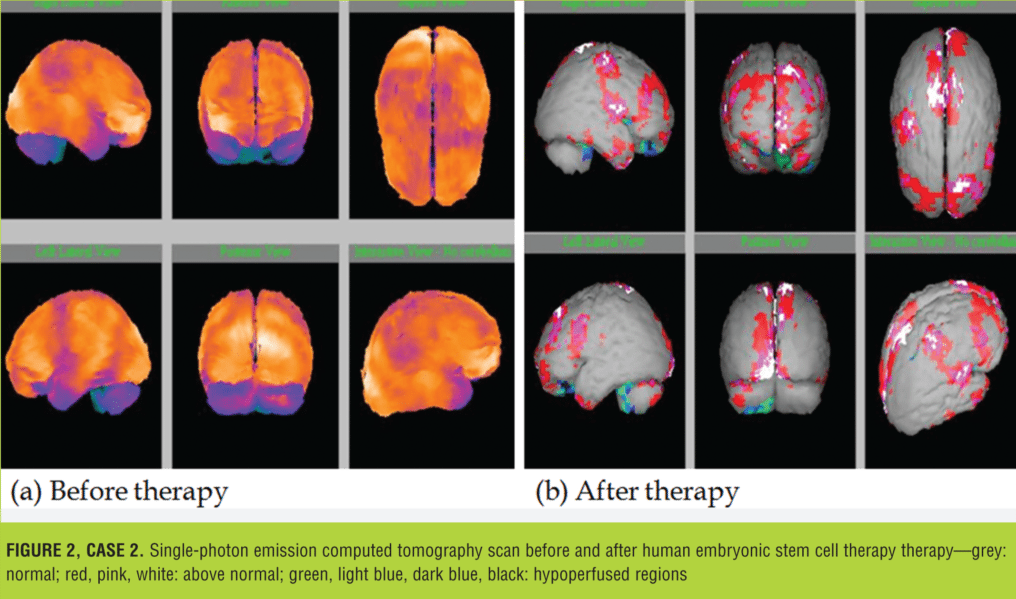 在大腦和小腦區(qū)域觀察到的灌注程度顯著降低(圖 2) 在大腦和小腦區(qū)域觀察到的灌注程度顯著降低(圖 2)