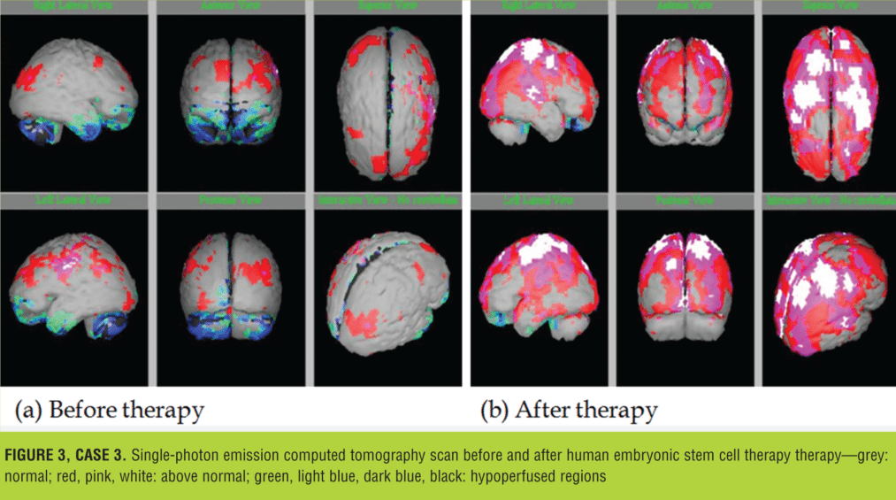 與之前的掃描結(jié)果相比,2014 年 1 月 9 日的 SPECT 掃描顯示腦灌注流正常(圖 3) 與之前的掃描結(jié)果相比,2014 年 1 月 9 日的 SPECT 掃描顯示腦灌注流正常(圖 3)