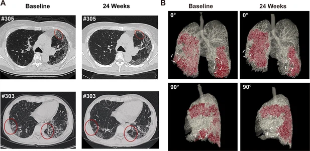 圖4:REGEND001治療前后的代表性肺部CT圖像。 圖4:REGEND001治療前后的代表性肺部CT圖像。