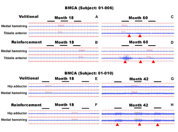 BMCA 識別自愿或強化動作引發的 EMG 活動