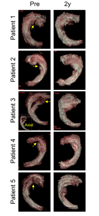 移植滑膜間充質(zhì)干細胞修復(fù)前后的3D MRI圖像