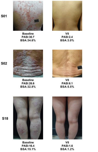 3 位患者治療前后的代表性皮膚圖像


