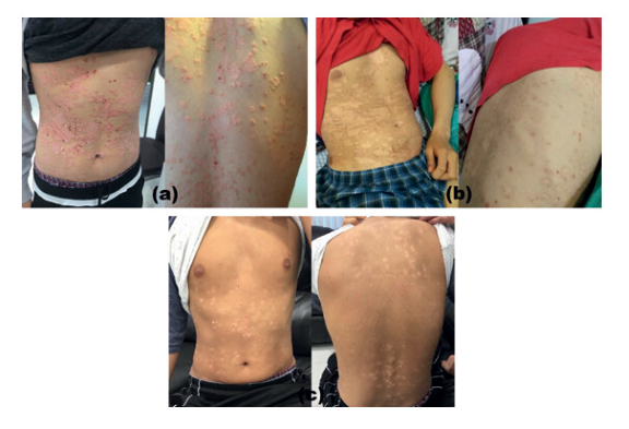 G-MSC 輸注對(duì)患有 5 年嚴(yán)重斑塊性銀屑病的 19 歲男性的影響。