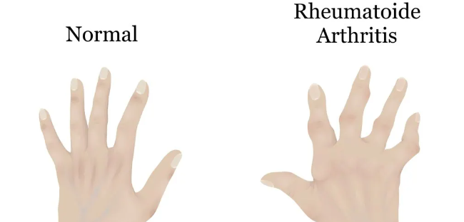 干細(xì)胞治療類(lèi)風(fēng)濕關(guān)節(jié)炎：如何實(shí)現(xiàn)從短期關(guān)節(jié)功能改善到長(zhǎng)期的生活質(zhì)量提升？