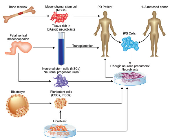 圖 (1)。不同類型的干細胞可用于帕金森病的修復。