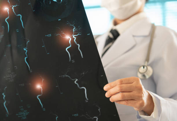 骨髓干細胞治療缺血性卒中靠譜嗎?網絡薈萃分析給出答案 骨髓干細胞治療缺血性卒中靠譜嗎?網絡薈萃分析給出答案